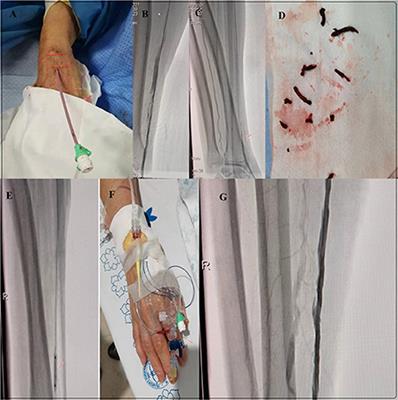 Retrograde recanalization of radial artery occlusion via the distal transradial artery: A single-center experience
